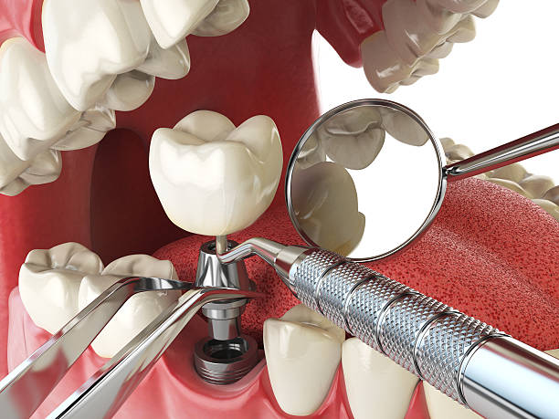 Best Emergency Wisdom Teeth Removal in Hansen, ID
